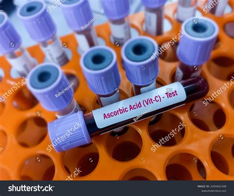 High Ascorbate in blood sample .